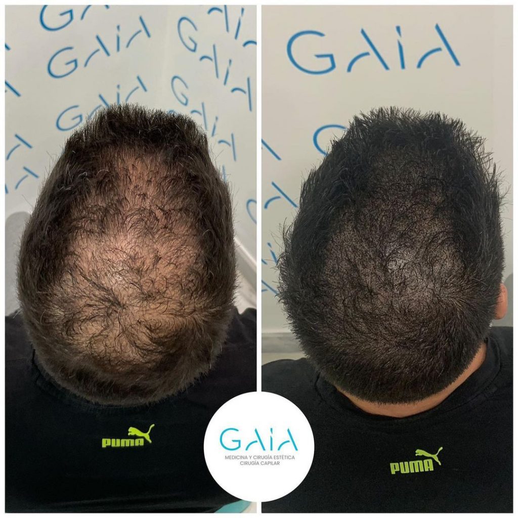 resultados injerto capilar