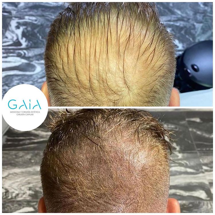 resultados injerto capilar