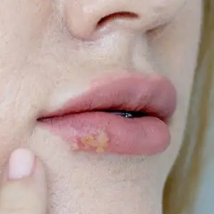 aumento labios y herpes labial