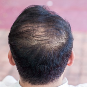 minoxidil pelo