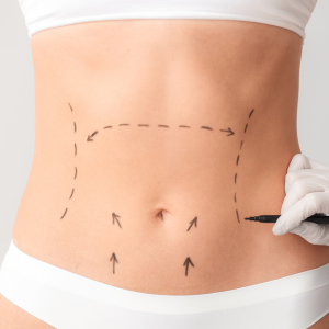 Cirugía de abdominoplastia en Cartagena realizada en Epical Clinic