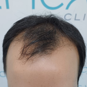 Prevenir la caída del cabello con tratamientos en Cartagena en Epical Clinic