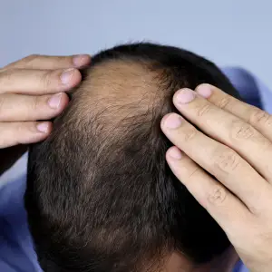 Tratamiento para la caída del cabello