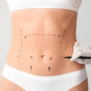 abdominoplastia