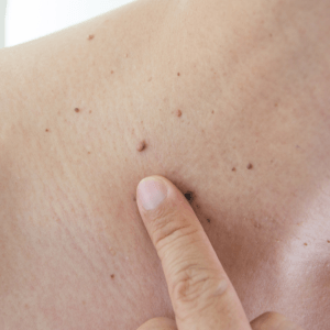 Crioterapia para eliminar verrugas en Cartagena