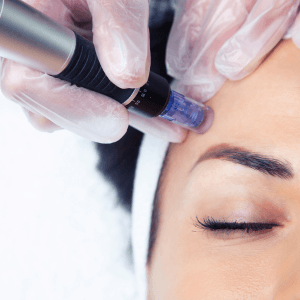 Dermapen profundidad cara