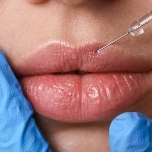 Los bultos de ácido hialurónico se disuelven