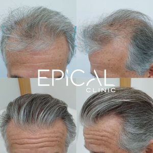 resultado injerto capilar