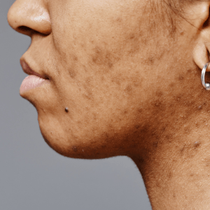 ¿Cómo eliminar manchas en la piel en Cartagena