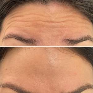 ¿Por qué el tratamiento con neuromoduladores es preventivo?