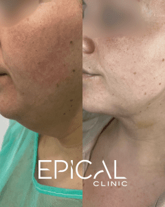 Lipoláser en papada