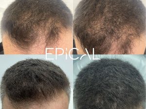 paciente con alopecia. Cada vez tenía más pérdida de cabello. Con tratamientos capialres específicos hemos dado más densidad a su pelo.