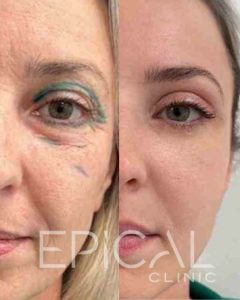 blefaroplastia