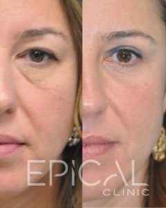blefaroplastia